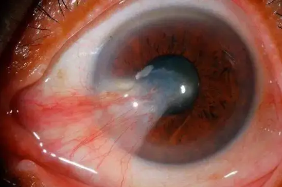 水蛭素是如何调理视网膜和白内障的？