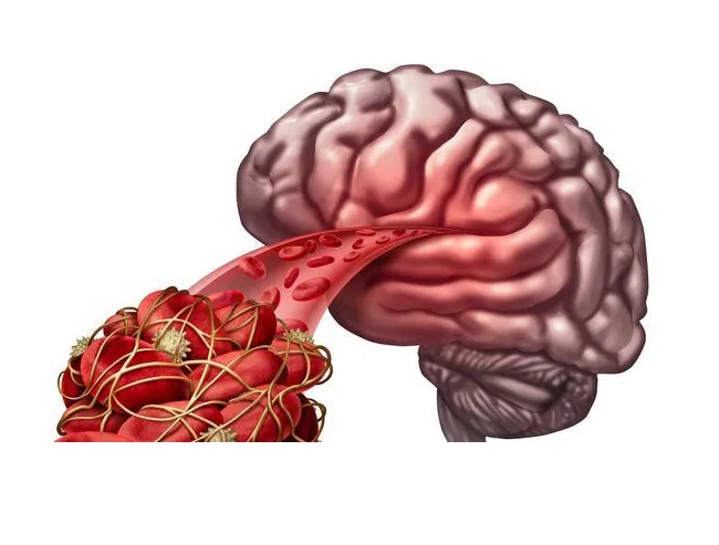 水蛭素抑制脑出血后脑水肿作用