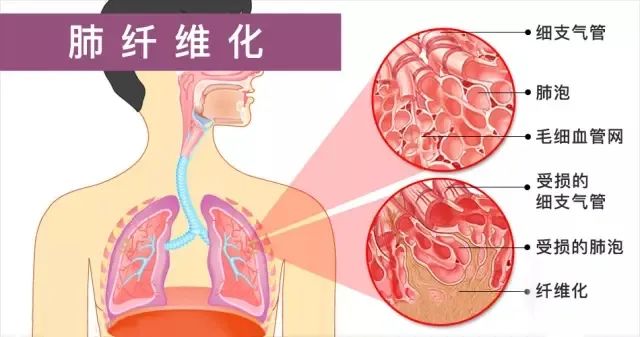 天然水蛭素可改善肺纤维化？