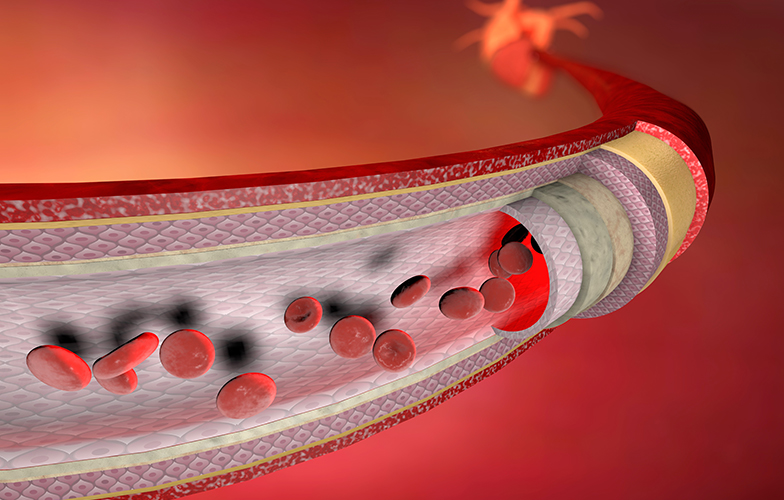 水蛭素可以溶解血管斑块吗？